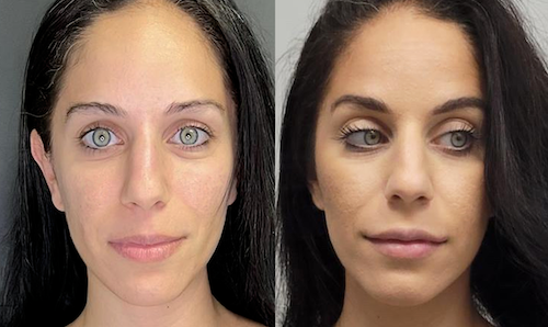 Defined Lip Shape Before After Mississauga Lip Doctor